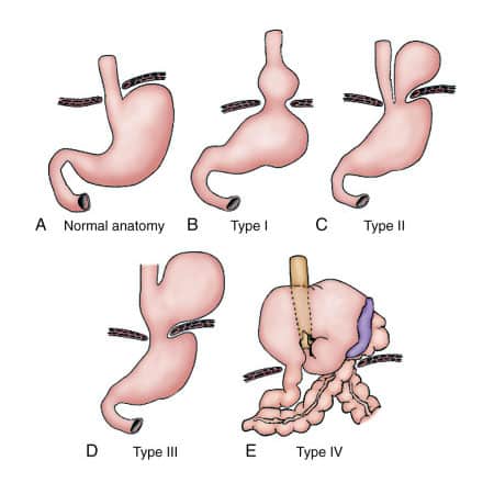 Paraesophageal Hernia