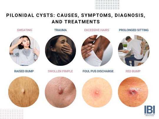 SiLaC® Pilonidal Cysts - Safest Cyst Removal Laser Therapy