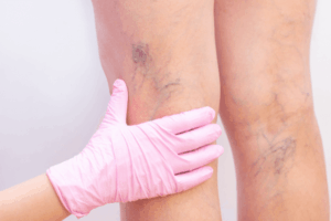 What Causes Varicose Veins