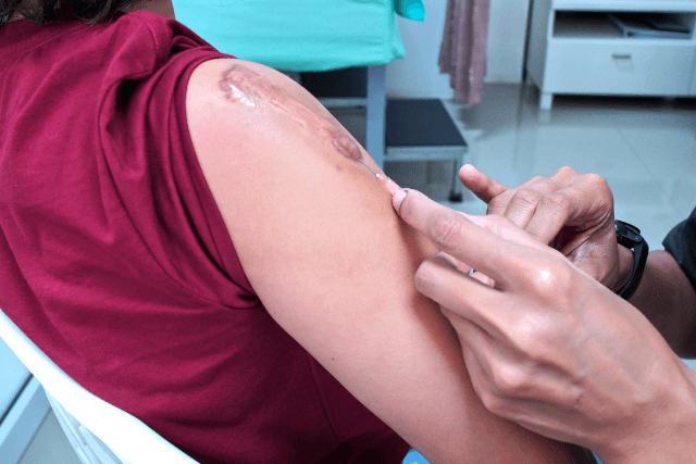 Treatment for Keloids