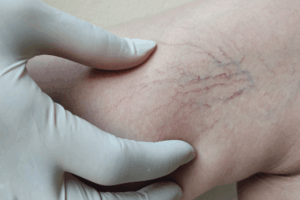 Sclerotherapy for Spider Veins