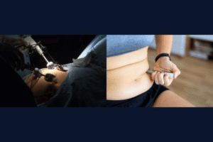 Comparing Gastric Sleeve vs. Wegovy