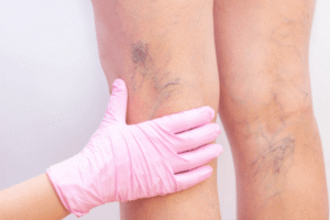 Bulging Blue Veins